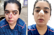 Bengaluru woman alleges Zomato delivery man hit her, shows bloody nose