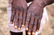 Health Ministry issues guidelines for the management of Monkeypox