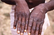 Monkeypox scare: Union Health Ministry issues new guidelines to states, UTs