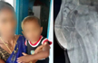 Telangana doctors shocked as 11 needles found in 3-year-old baby’s body