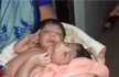 Rare conjoined twins born in Odisha with 2 heads, 3 hands