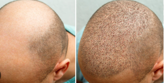 Why Hair Transplant Turkey Is a Top Destination for Hair Restoration