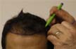 Mumbai Businessman dies after getting 12-hour hair transplant