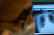 Covid-19 patients at risk of developing lung fibrosis